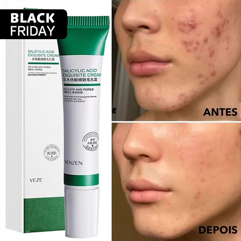 Creme De Ácido Salicílico 20g Para Remoção E Clareamento De Poros/Acne ...