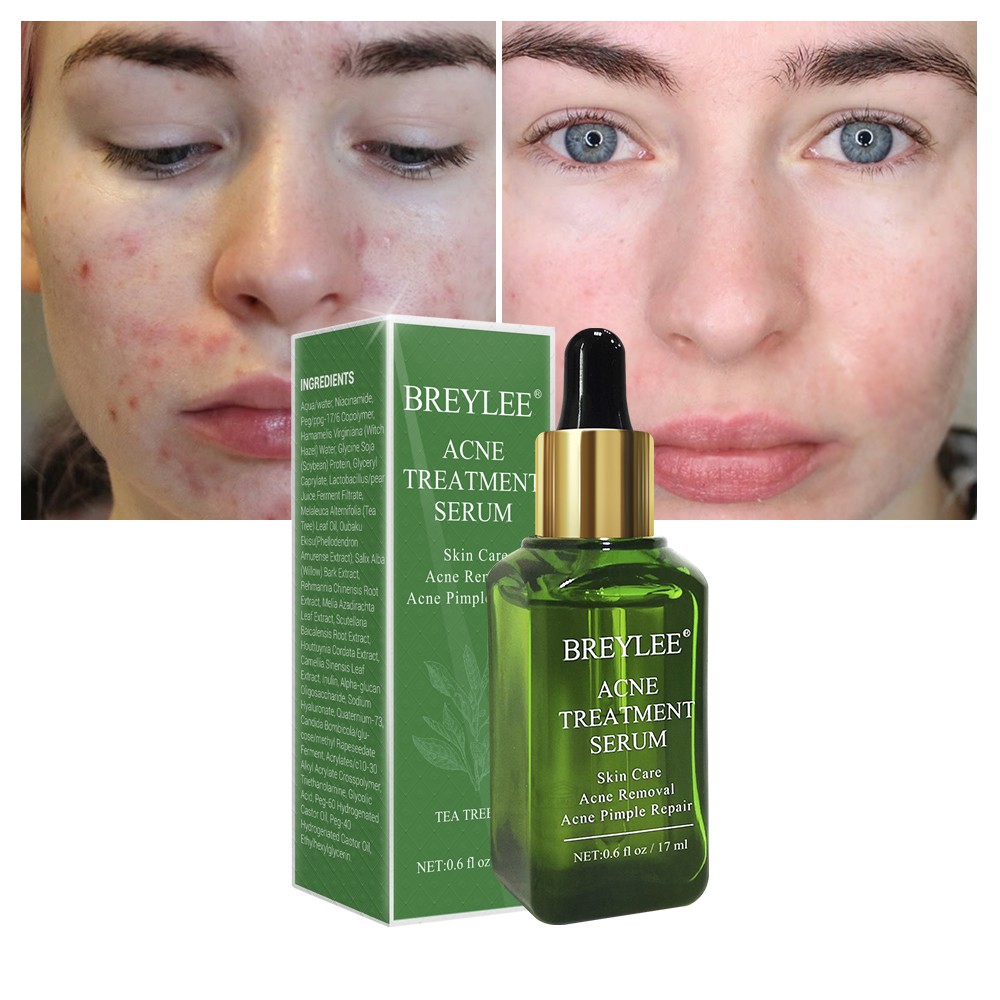 Soro De Tratamento De Acne Anti Creme De Remo o De Cicatriz Remover 