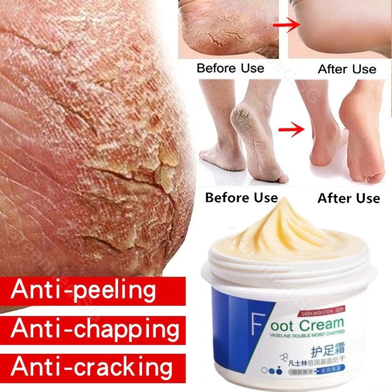 Creme Anti-Rachaduras Para Pés Calcanhares Rachados E Secos ...