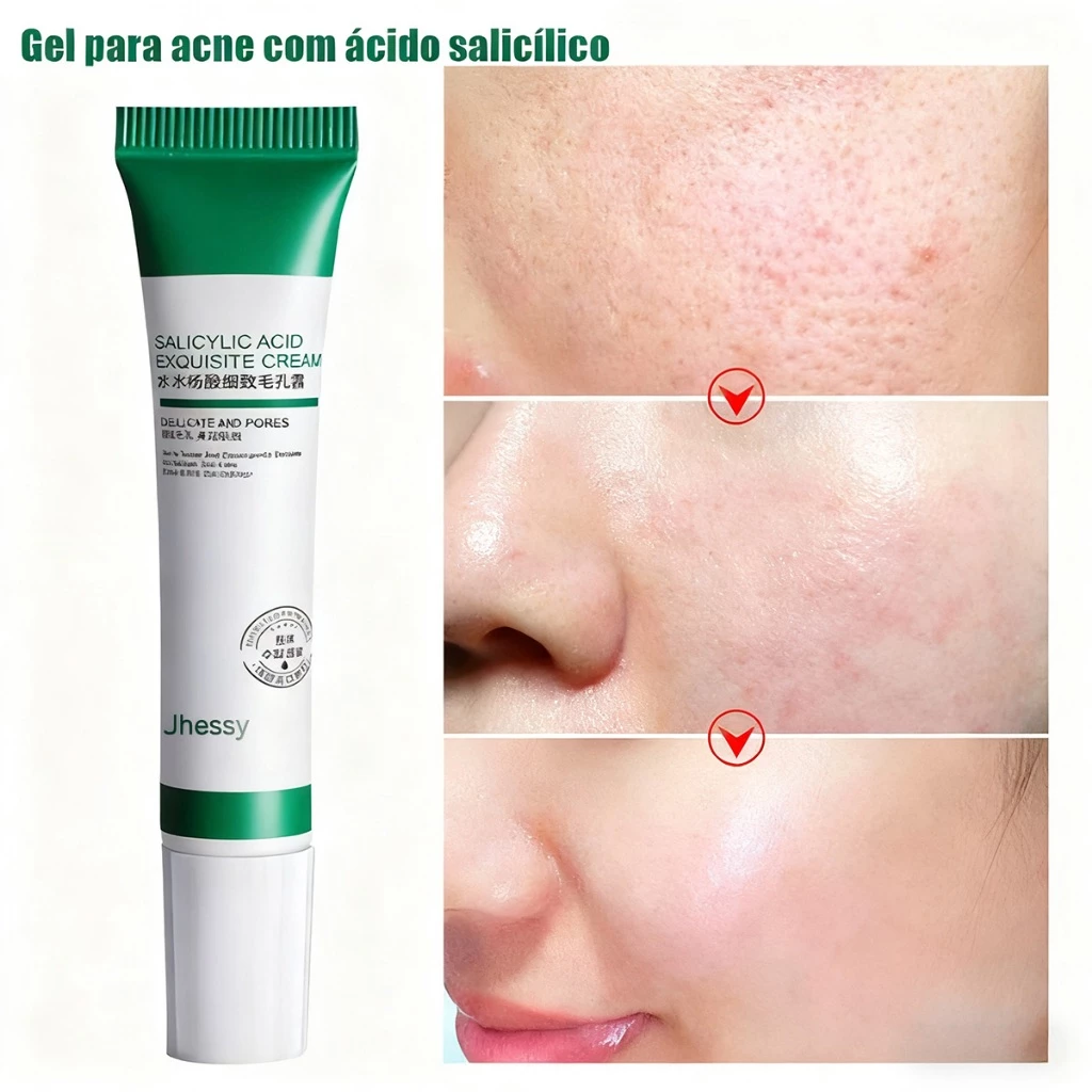 Creme De Ácido Salicílico 20ml Para Remoção E Clareamento De Poros/Acne ...