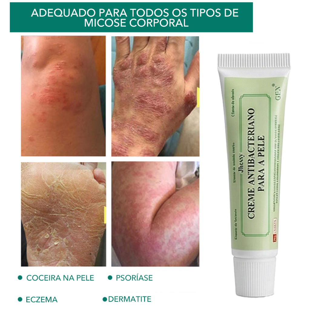 Pomada cremosa para cuidados com o corpo para dermatite, eczema e ...