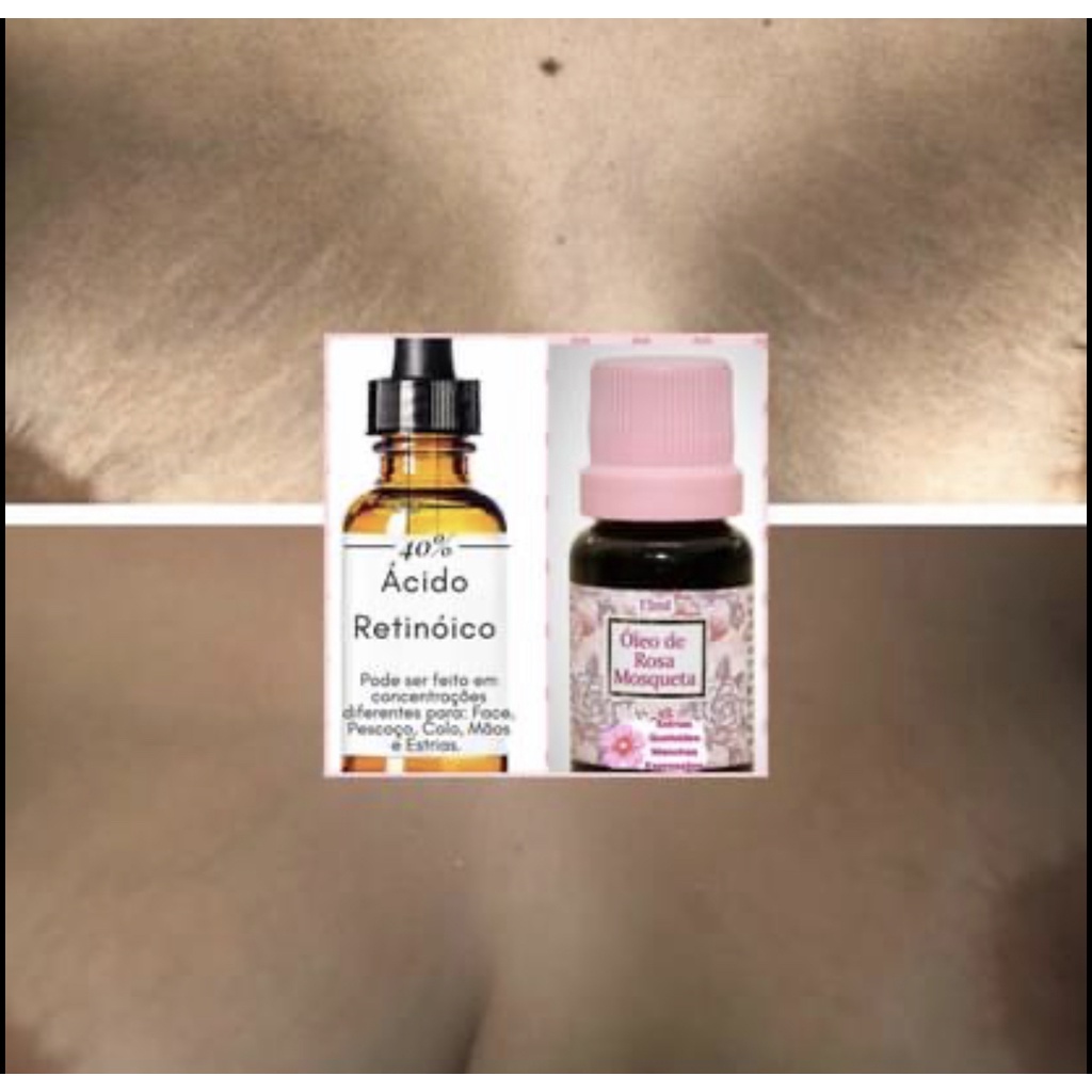clareador de estrias acido retinoico 30ml + brinde