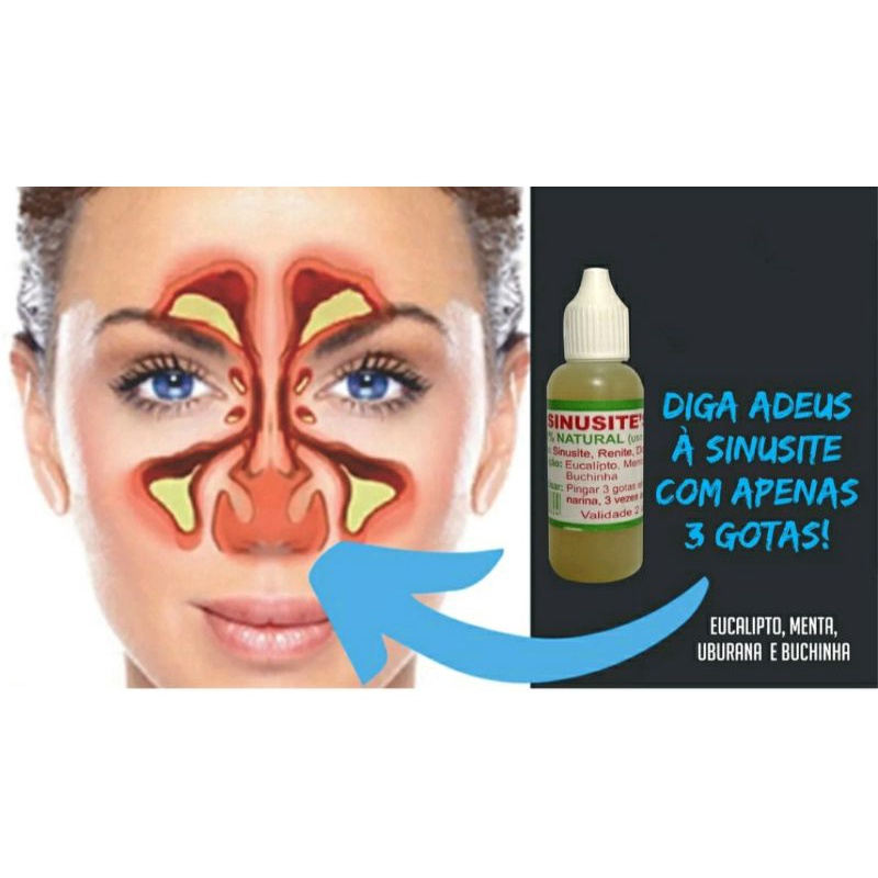 Milagroso Natural Trata Sinusite, Renite e dor de cabeça 100% NATURAL ...