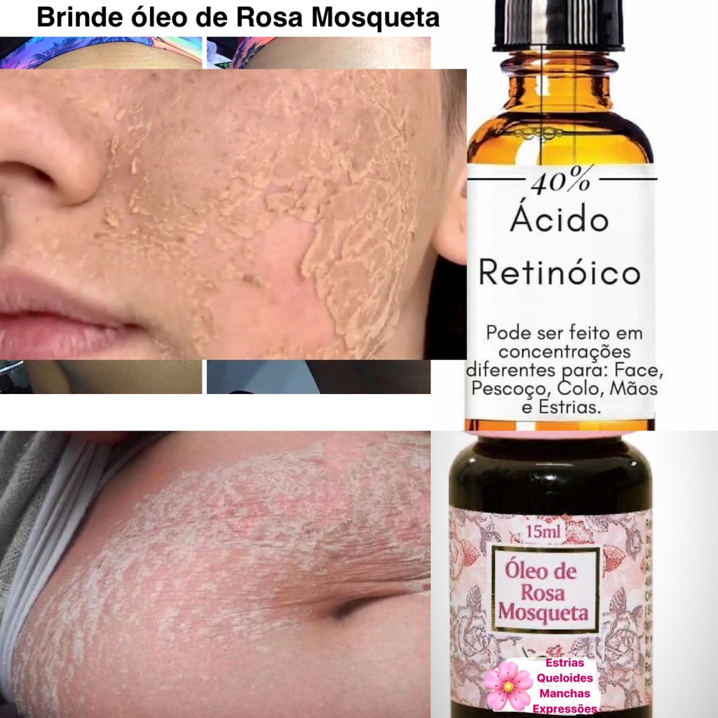Removedor de estrias (Àcido retinoico + oleo de rosa mosqueta brinde )