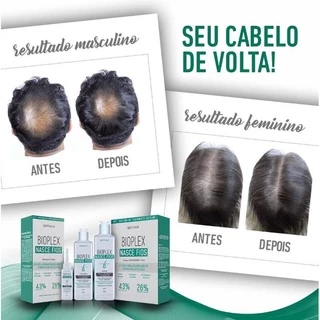 Kit Bioplex Nasce Fios e Antiqueda Tratamento Capilar (Shampoo e Tônico) Soft Hair