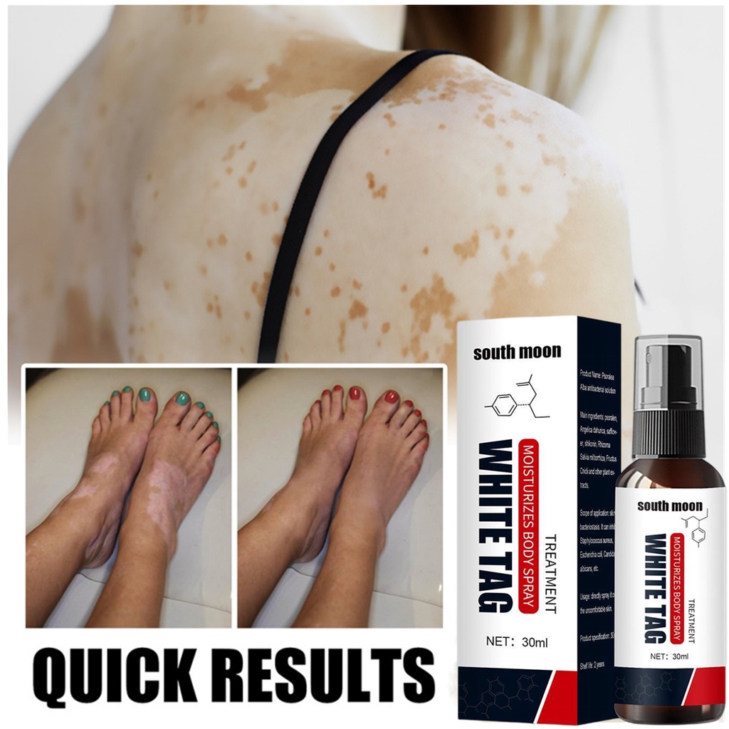 EELHOE Vitiligo Spray De Tratamento Para Pele Leucoplasia Removedor De White Spot Repair Tag Covering 30ml