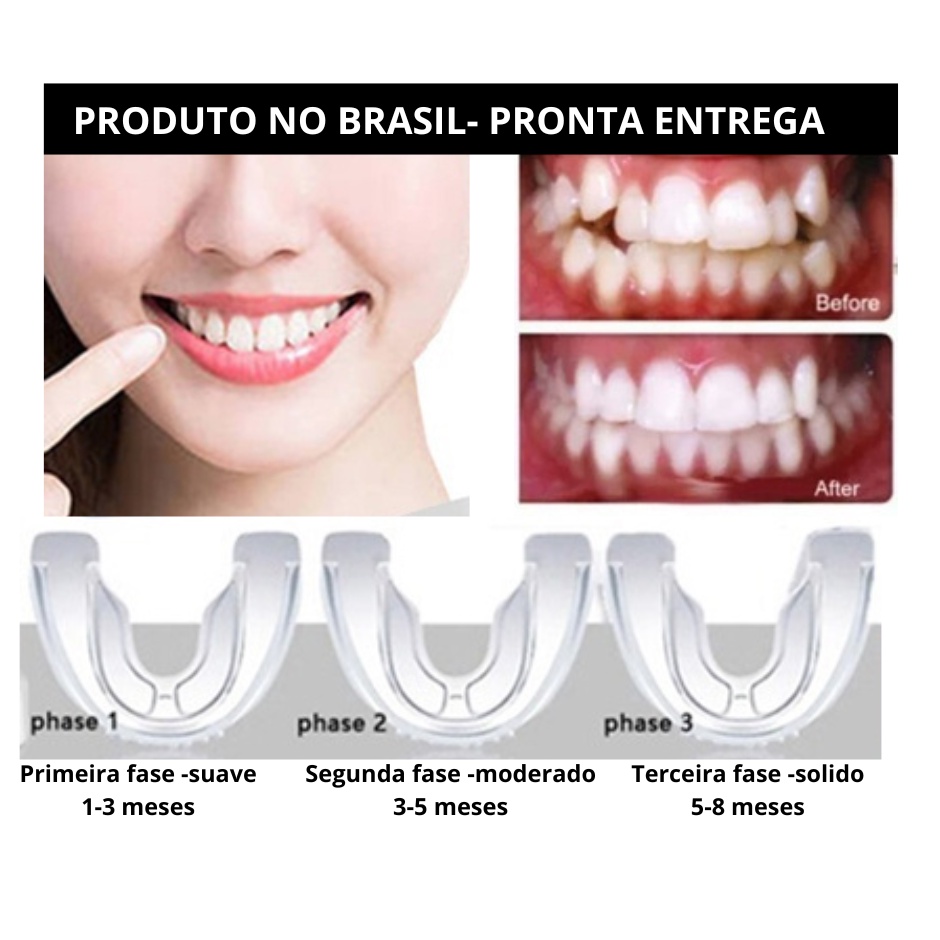 Aparelho Ortodôntico Nova Geração 3 Etapas Alinhador Dental - Preço de Unidade -Sorriso perfeito sem aparelho metálico- Pronta entrega