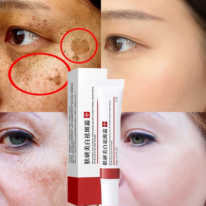 Produtos para Clarear Manchas de Melasma: Onde Comprar | BuscaProdutos