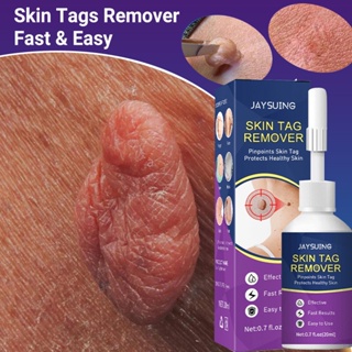 Skin Tag Removedor De Verruga Essencial Sem Dor Tratamento Escura Etiquetas Planas Papilloma Cuidados Com O Corpo De Beleza Genital