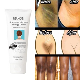 Dark Privates Fast Whitening Cream Pigmentation Correctores De Pigmentação Rápida Para A Pele Preta Cotovelos De Mão Removedor De Manchas Intensas Do Joelho