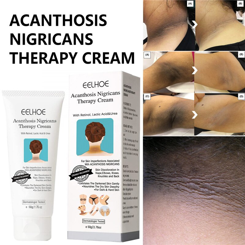 Acantose Nigricans Therapy Cream Removendo Cotovelo Escuro Manchas De Joelho Tornozelo Canto Axila Creme Clareador Corpo