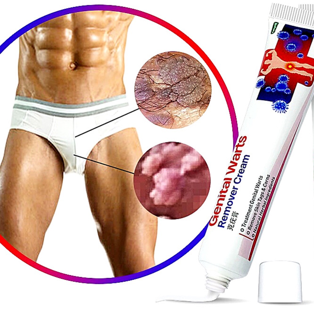Pomada Elimina Verrugas Genitais Creme De Hpv 20g