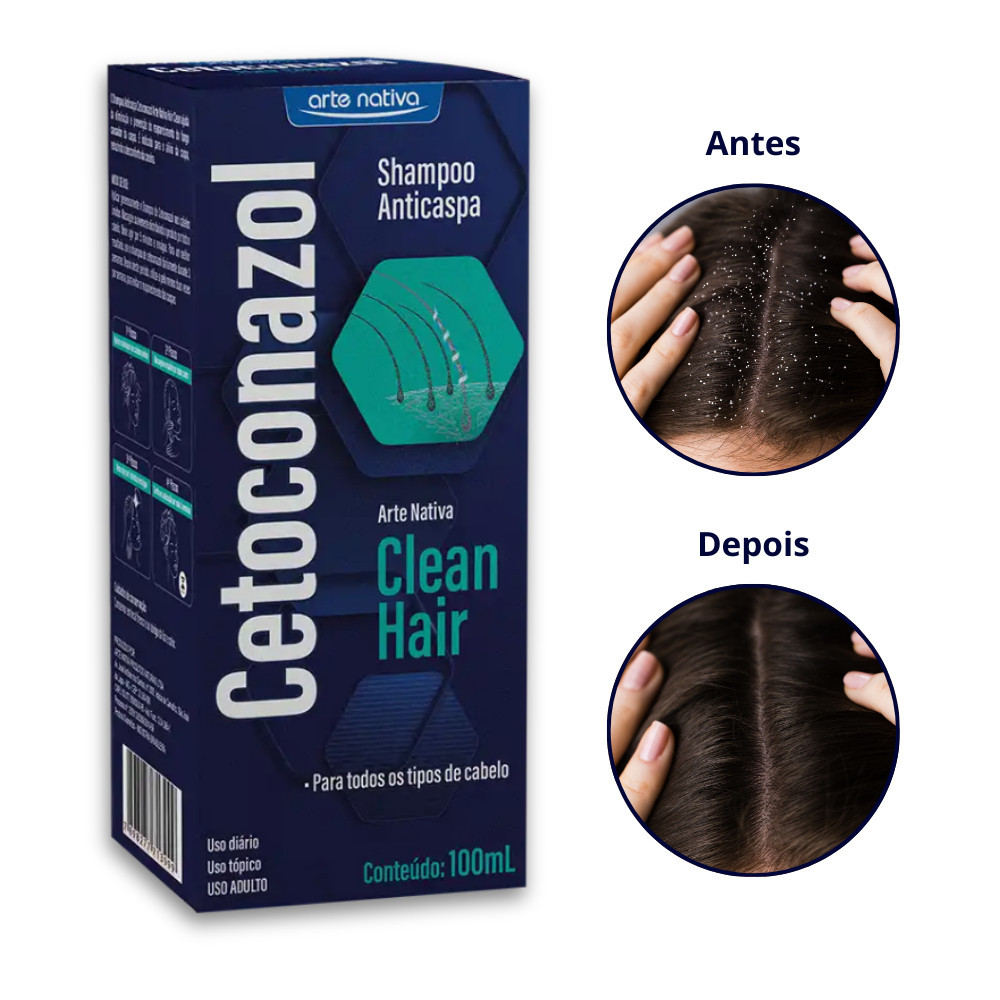 Kit 5x Shampoo Anticaspa, Coceira e Dermatite Seborreica Cetoconazol 1% ...