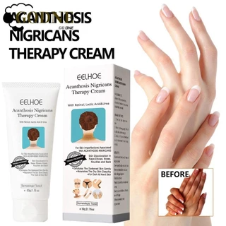 GODNESSFO Acantose Nigricans Therapy Cream 50g Glow White Moist Creme Corretor De Manchas Escuras