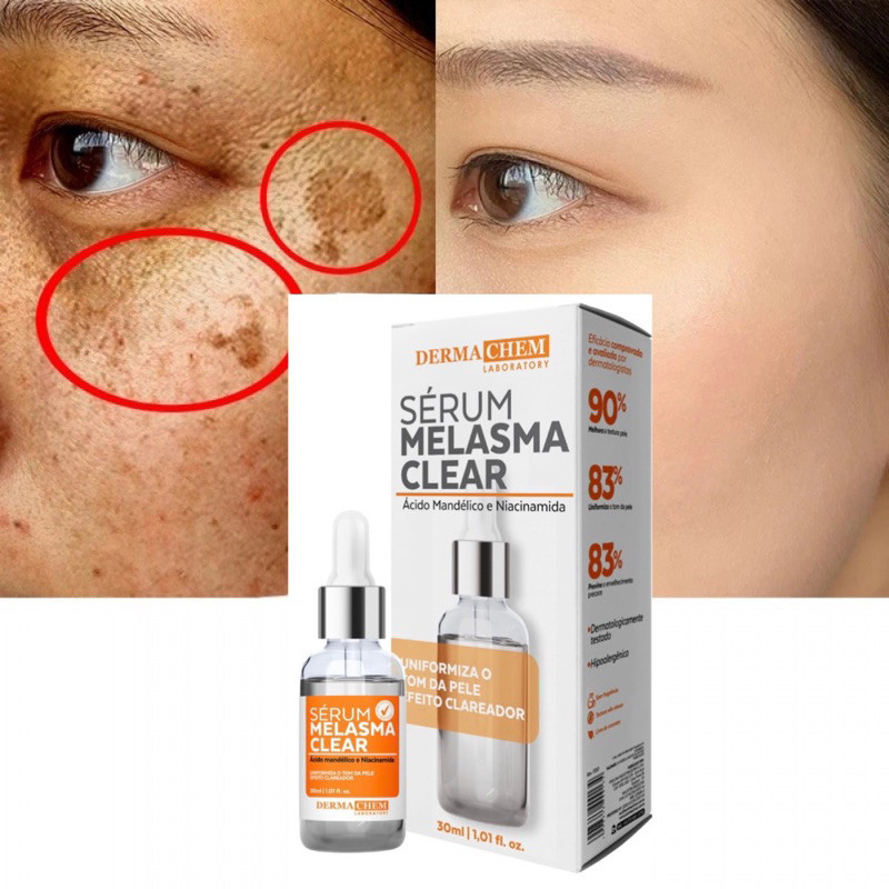 Serum Clareador de Manchas e Melasmas Cuidados com a Pele Dermachem ...