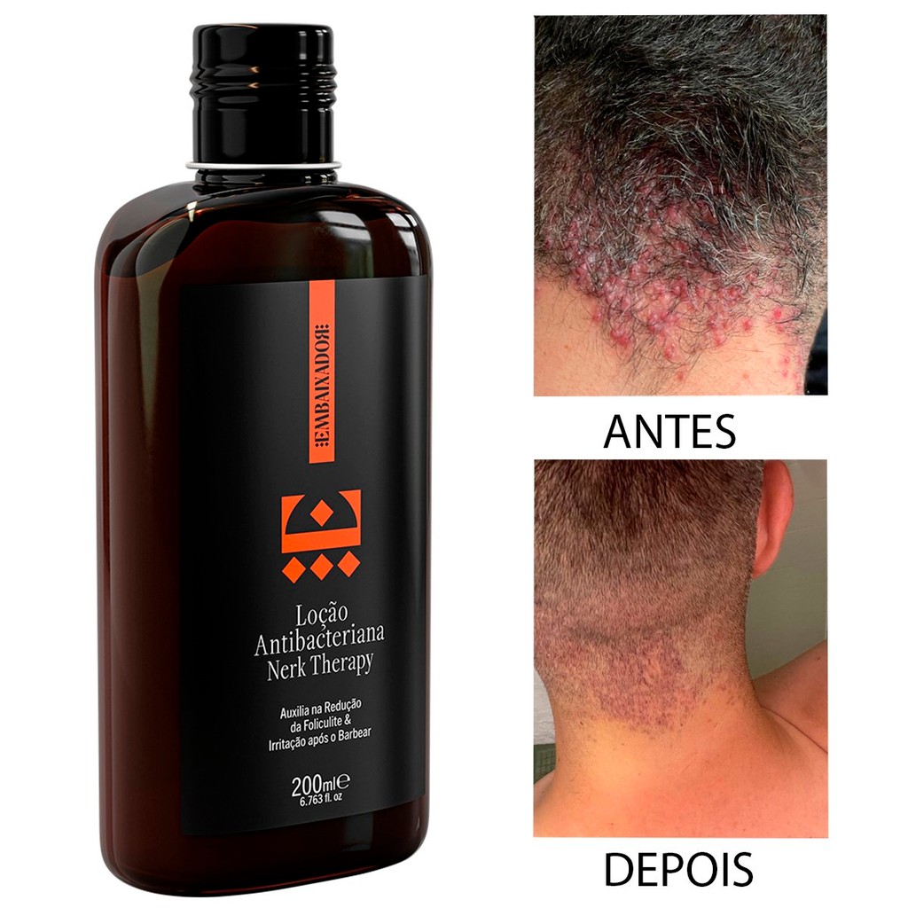 Loção Tratamento Foliculite e Pelos Encravados Embaixador 200ml ...