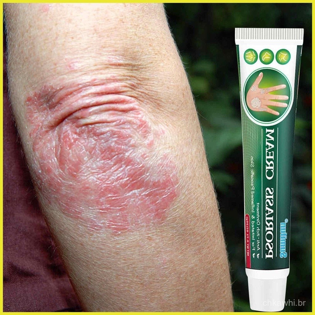 Dermatite Eczema Creme Para Coceira Tinea Pedis Urticaria Squamation ...