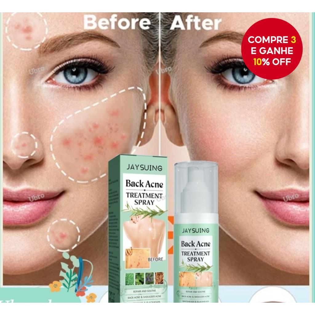 Spray para Acne e Espinhas com Ácido Salicílico 2% - Pele e Corpo Lisos ...