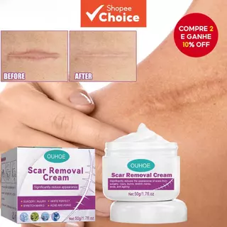 Creme De Gel Para Cicatrizes , Avançado Cirúrgico Seção Cirúrgica , Abdominoplastia E Quelóide 50g em Oferta na Shopee