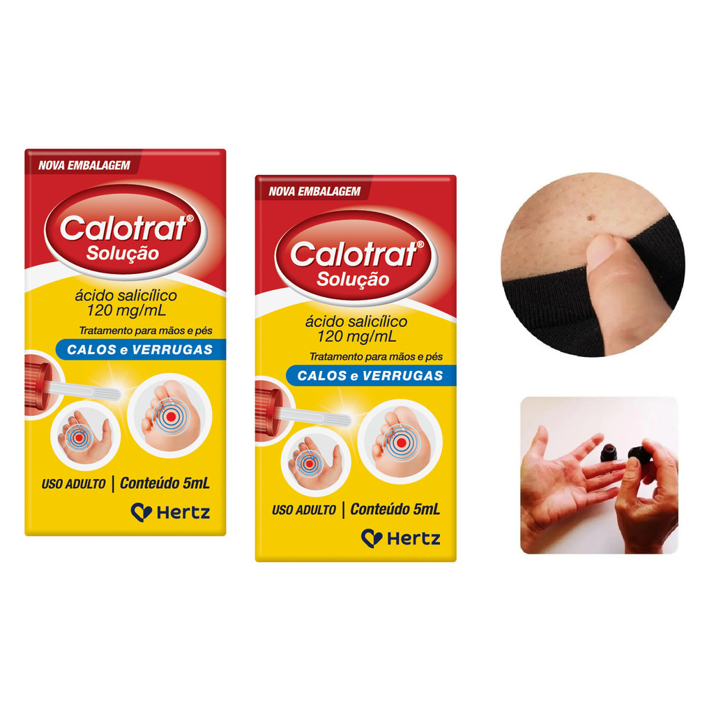 Calotrat 5ml Anti Verruga Ácido salicílico 0,12 g/mL Hertz Verrugas ...