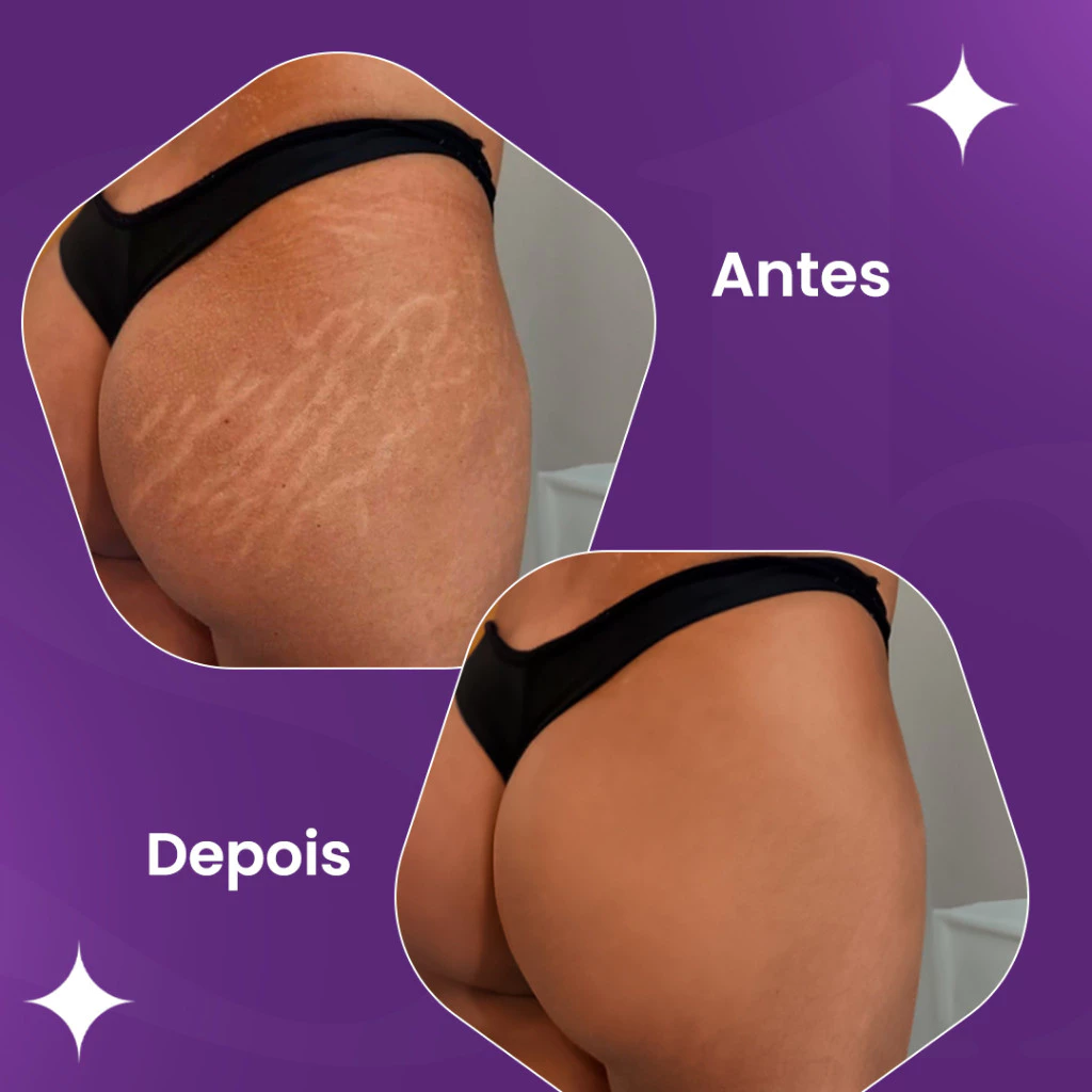 Comparativo visual de pele antes e depois do uso do tratamento para estrias