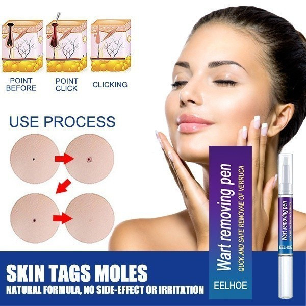 3ml Qu Yu Gao Fu Ping Eye Pomada Para Verrugas Planas Zi Dot Mole ...