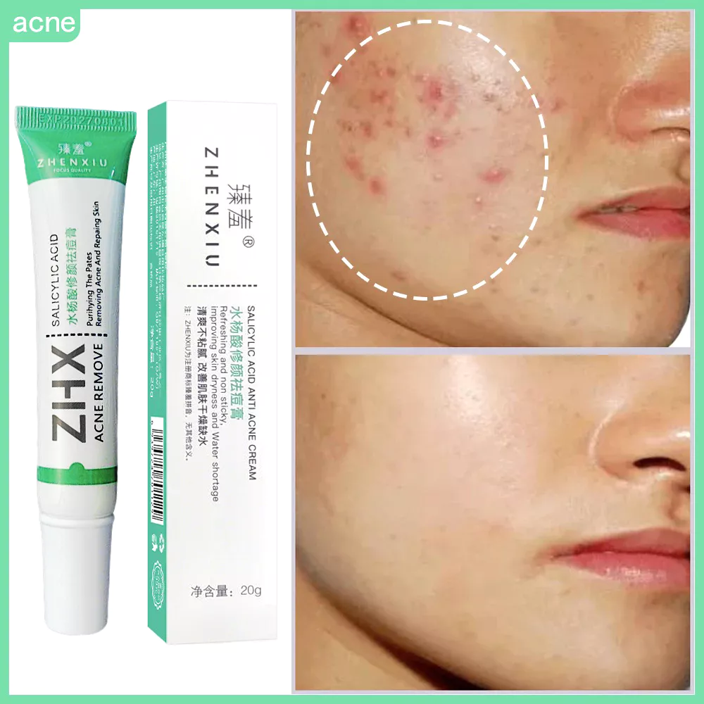Ácido Salicílico Acne Creme Remover Cravo Controle De Óleo Anti-Tratamento Reparação Espinha Cicatriz Clareamento Facial